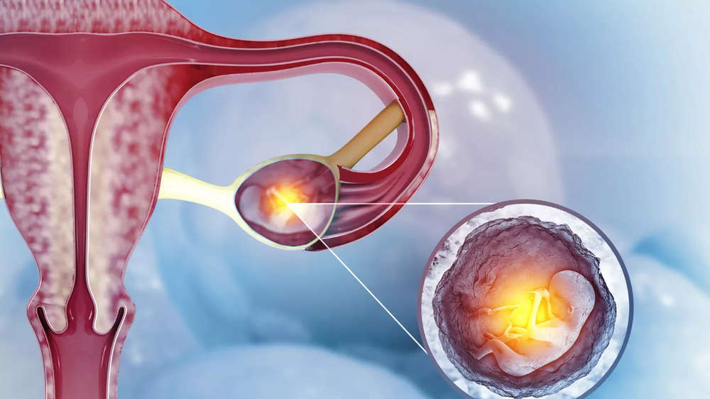 Ectopic Pregnancy