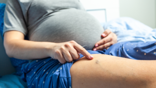 Varicose Veins During Pregnancy: Types, Causes &amp; Treatment