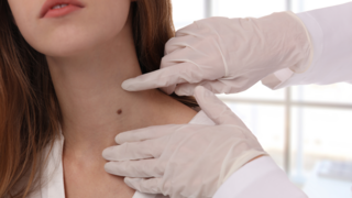 Why Some Women Grow More Moles or Skin Tags in Pregnancy