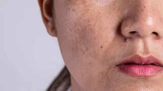 Why Skin May Darken During Pregnancy