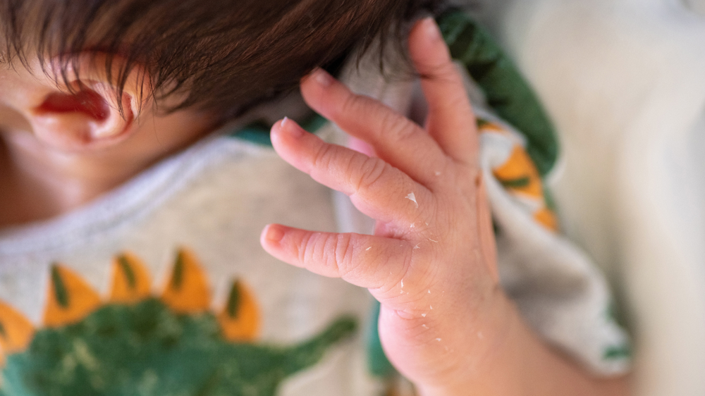 baby peeling skin