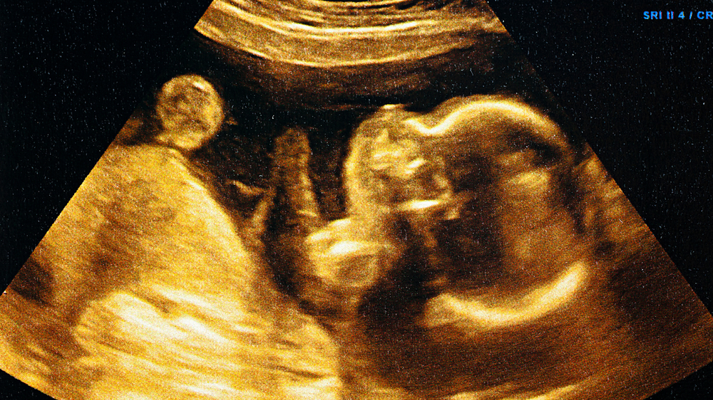 Is it possible to be pregnant without a baby bump Myths and facts