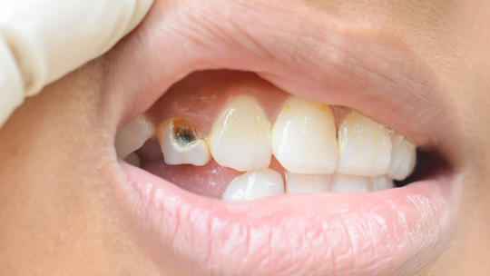 Cavities, Infection & Fertility: Why Untreated Dental Issues Matter