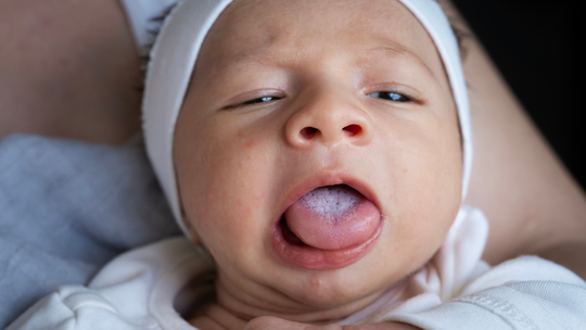 Is My Baby's White Tongue Oral Thrush, or Just Milk?