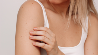 Skin Tags During Pregnancy and Gestational Diabetes: Understanding the Connection