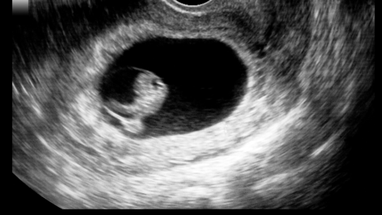 How Does the Embryo Attach to the Uterus During Early Pregnancy?