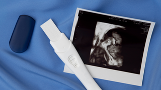 Vanishing Twin Syndrome: When One Twin Disappears