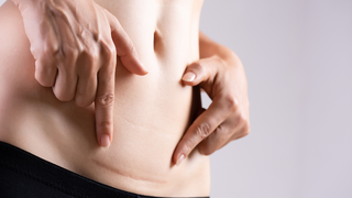 Why Do C-Section Scars Itch Months Later?
