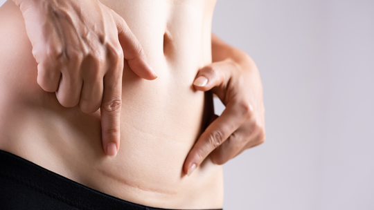 Why Do C-Section Scars Itch Months Later?