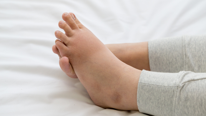 fluid retention during pregnancy2