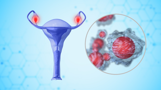 PCOS and Pregnancy: What Changes Once You Conceive
