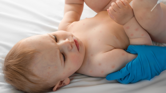 Red Birthmark in Babies: Could It Be a Strawberry Hemangioma?