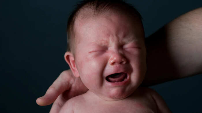 Hirschsprung disease in babies2