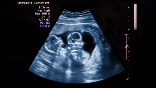 What Does It Mean When Twins Share One Placenta?