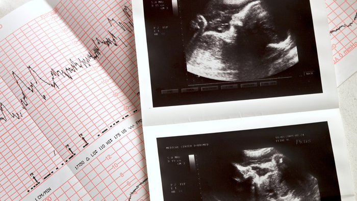 foetal arrhythmia during pregnancy2