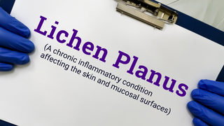 Lichen Planus of the Vulva: Symptoms, Causes, and Treatment