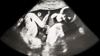 Superfetation: Can a Woman Get Pregnant While Already Pregnant?