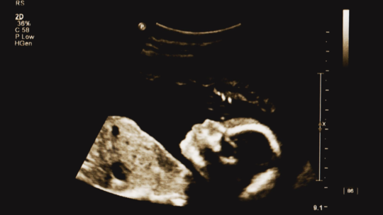 Can a Baby Smile in the Womb?