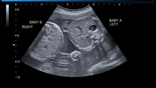 Can Twins Interact with Each Other in the Womb?