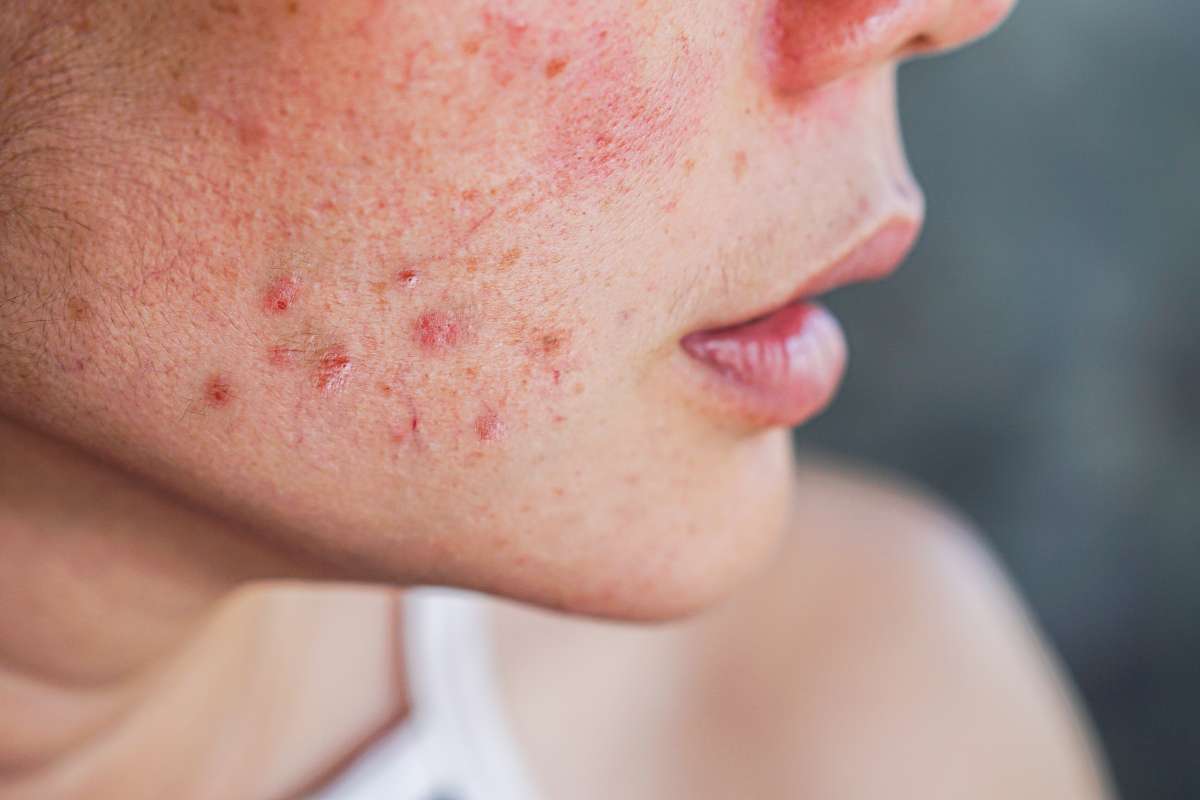 woman with acne- Symptoms Of PCOS