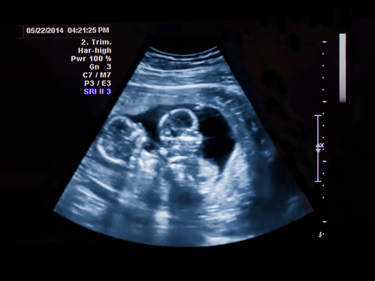 twin ultrasound-Multiple Gestation Complications
