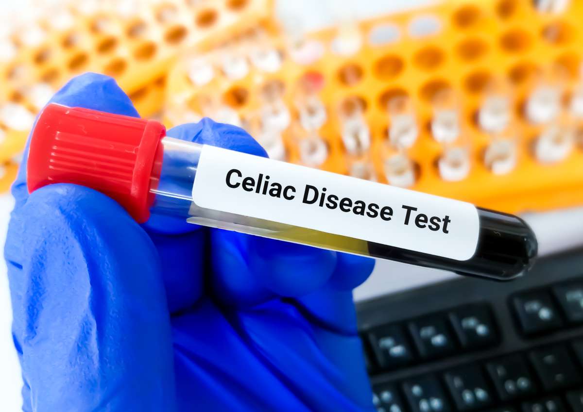 Blood sample tube for celiac disease test, help diagnose celiac disease and to evaluate the effectiveness of a gluten-free diet