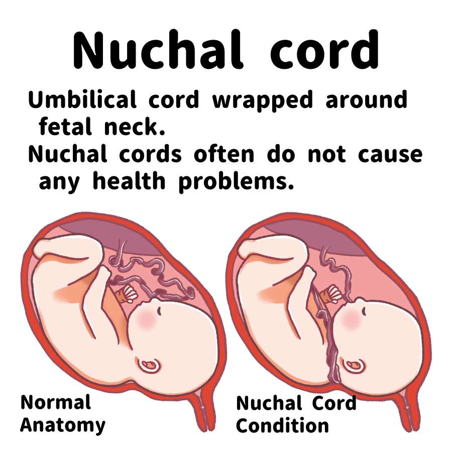 Nuchal cord