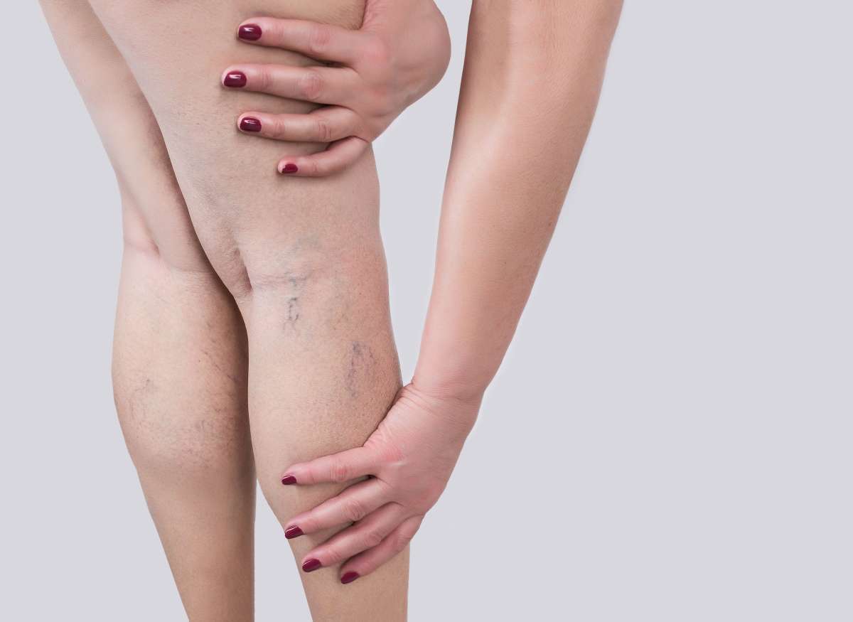 The varicose veins on a legs of woman- Varicose Veins And Circulatory Changes