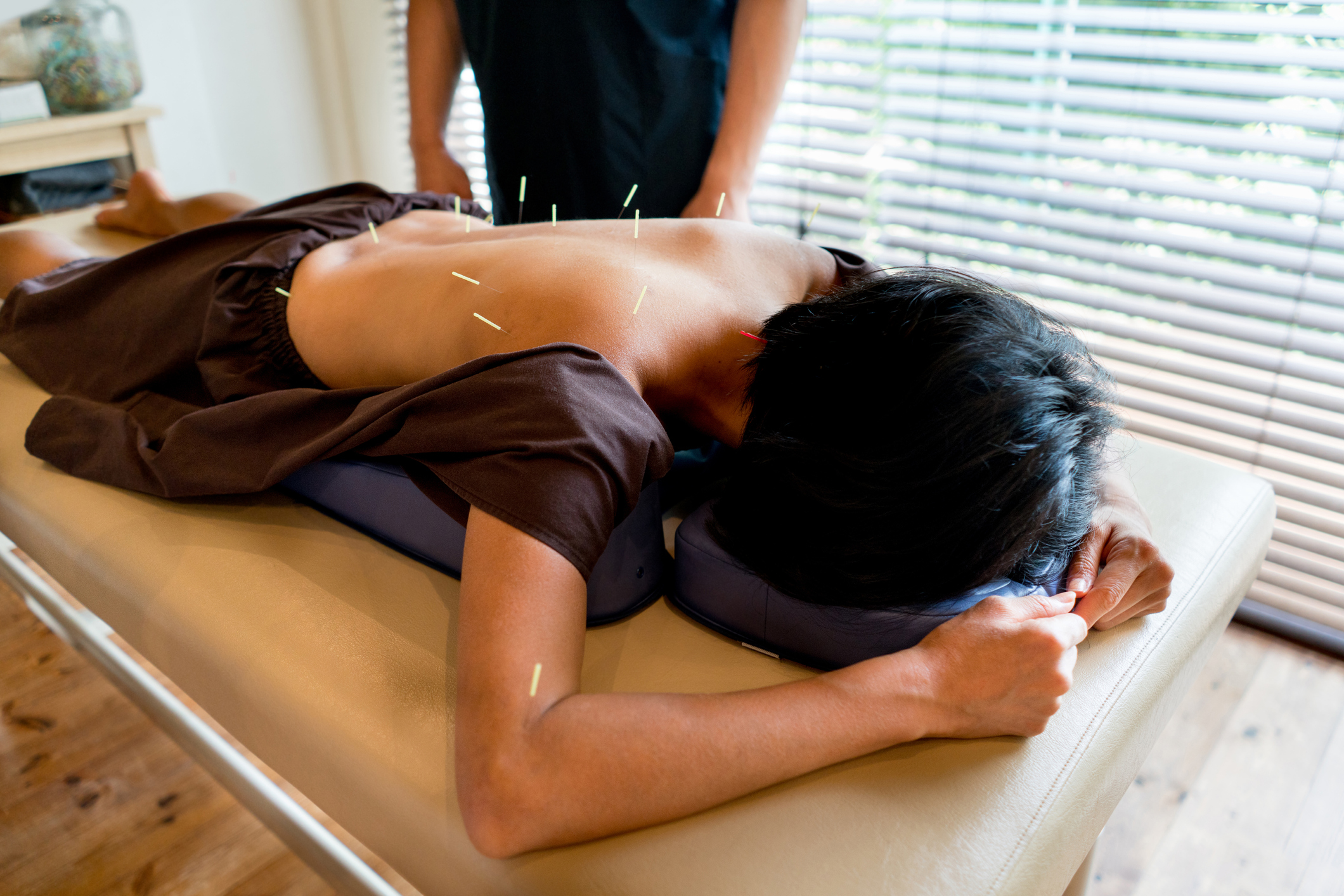 Woman getting acupuncture therapy