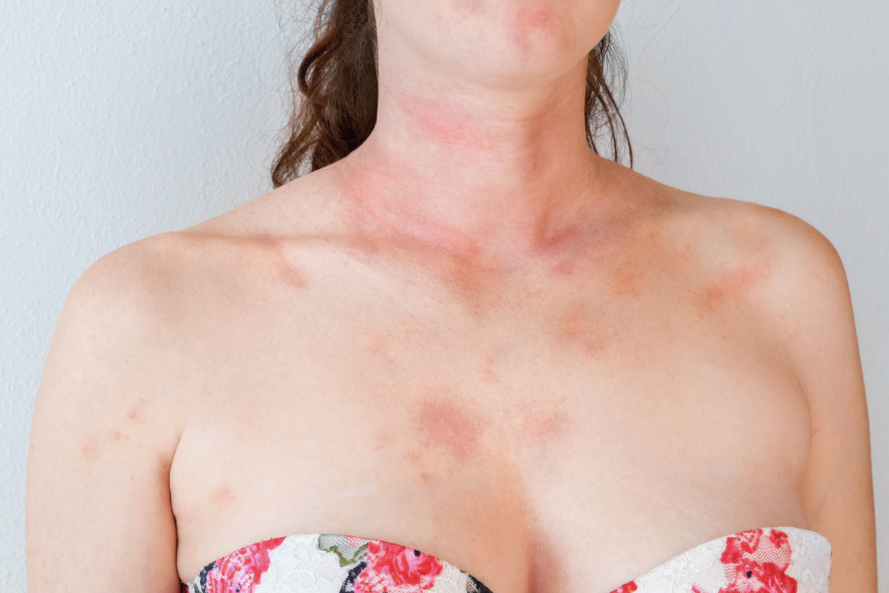 Allergic skin reaction on the female neck and face - red rash-Parvovirus B19 Infection 