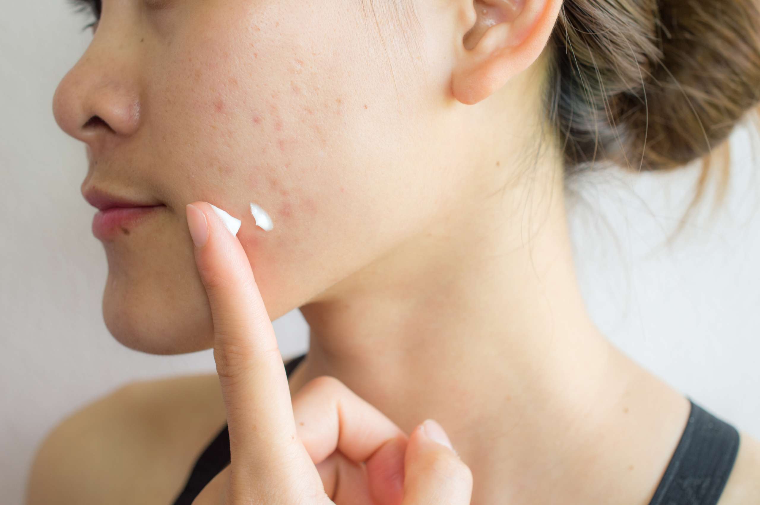 Portrait of young Asian woman having acne problem. Applying acne cream on her face- Skin Conditions Before Pregnancy
