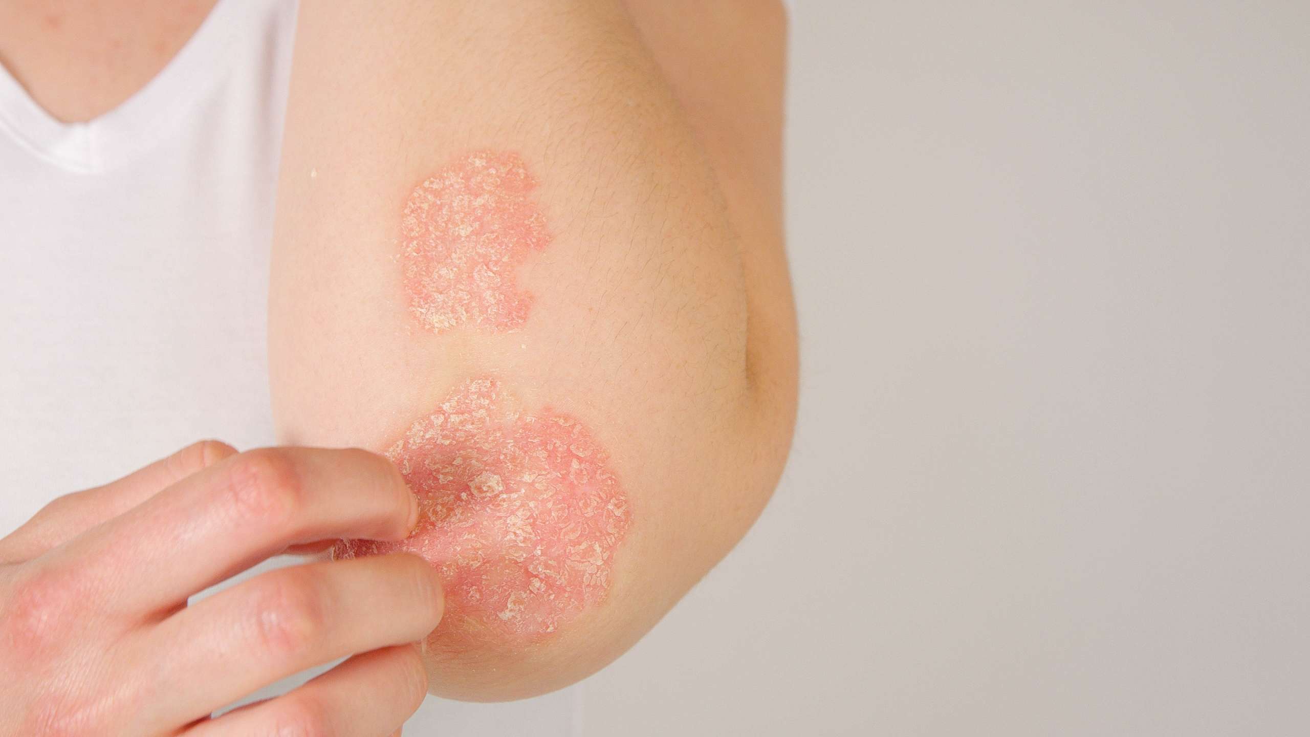 female patient suffering from psoriasis skin disease