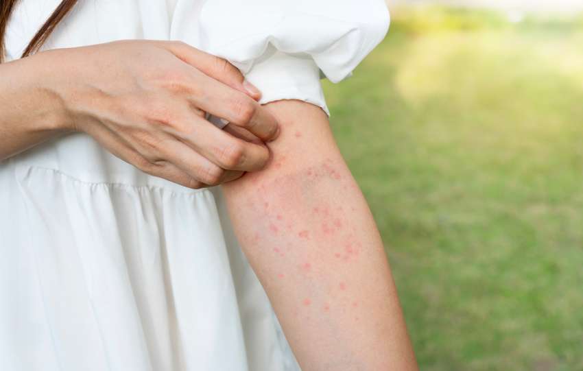 woman hand scratching her skin itchy. Allergic rash dermatitis eczema skin, insect, food allergy, health care concept