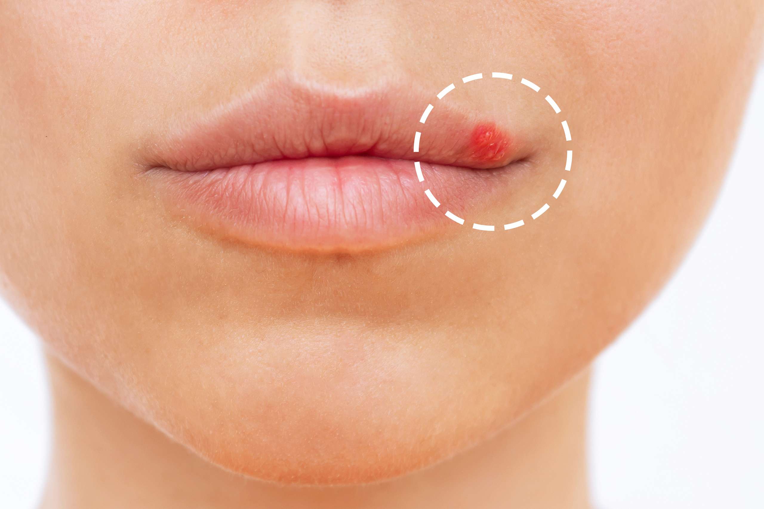 Herpes on the lip. Blisters on the mouth of a young woman-Herpes Simplex Virus 