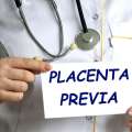 Pros And Cons Of Having Low Placenta: Understanding The Impact On Pregnancy